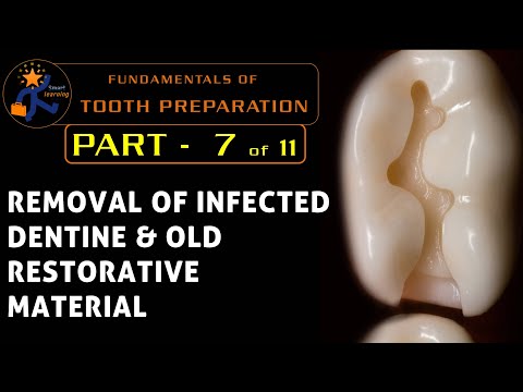 Fundamentals Of Tooth Preparation - Part 7 