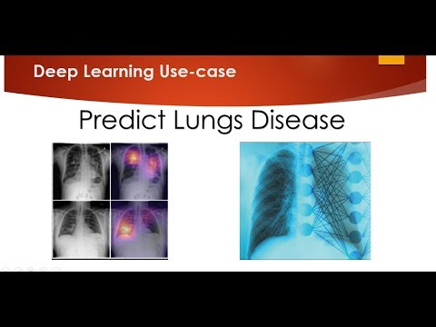 Predicting Lungs Disease using Deep Learning