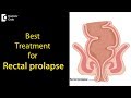 What Is A Rectal Prolapse How Is It Treated Dr Rajasekhar M R