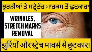 Download Lagu Wrinkles | Stretch Marks Removal - Ask Dr Sham Sunder Goyal MBBS, MD. Thumbnail