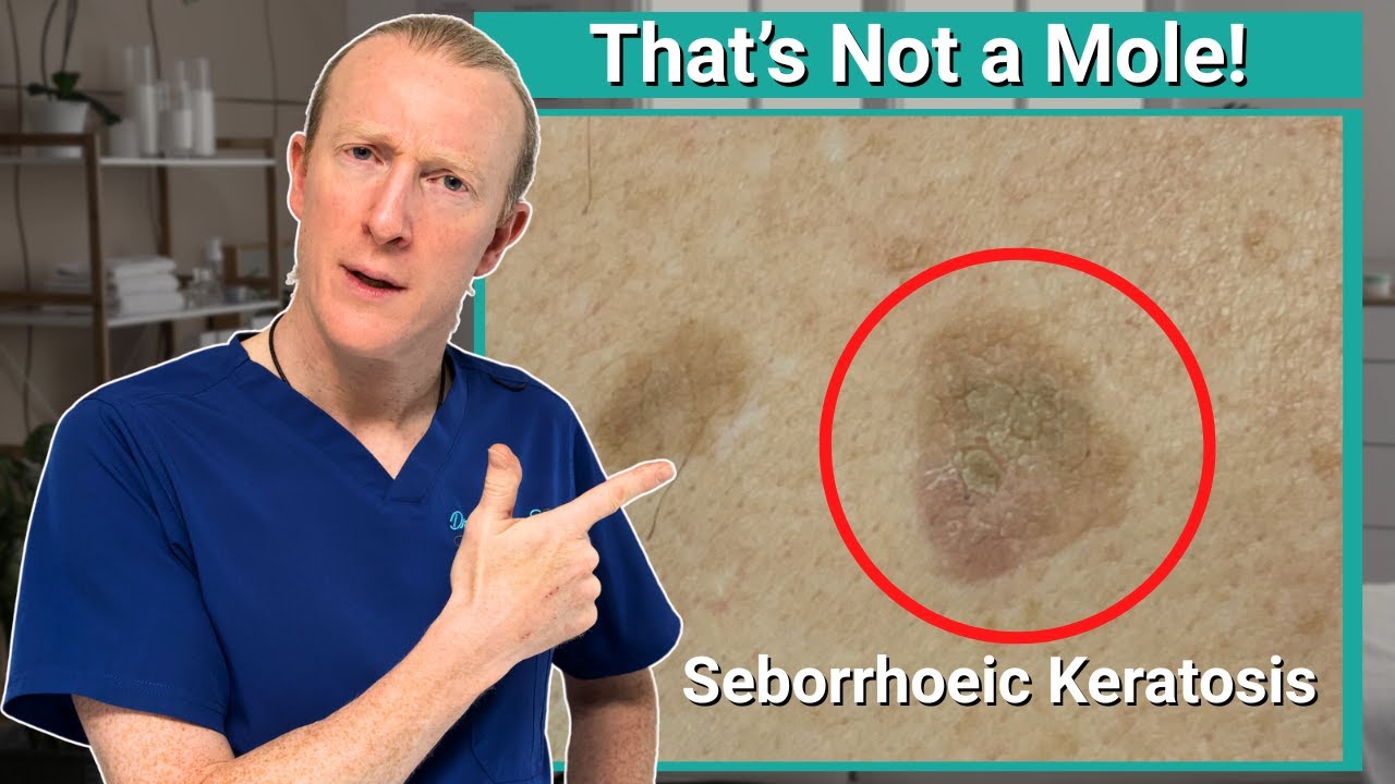 That's not a mole! Uncovering the Mystery of Seborrheic Keratosis