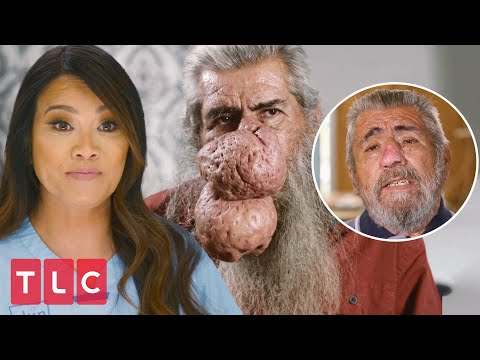 Update: See Roger After Life Changing Rhinophyma Removal | Dr. Pimple Popper