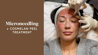 Microneedling Treatment & Cosmelan Peel For My Melasma! | Susan Yara