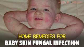Home Remedies For Baby Skin Fungal Infection | Activemomsnetwork | ActiveMomsNetwork