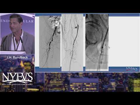 Access and Crossing Technique in SFA CTO Intervention   J  H  Rundback   PAD Session