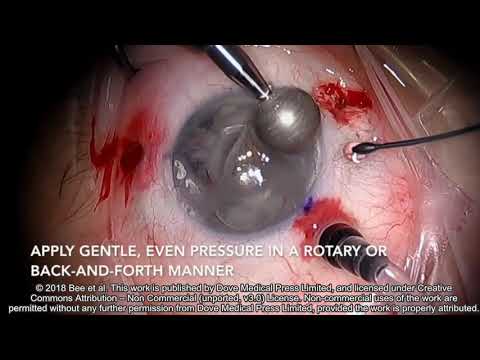 Band Keratopathy Removal Without Edta - Video