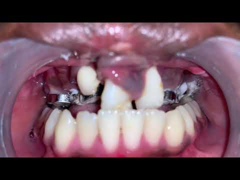 Underbite Correction With Anterior Maxillary Distraction