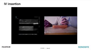 Advanced Peripheral Intravenous Skills for the Emergency Nurse: Using Point-of-Care Ultrasound for Difficult Access 