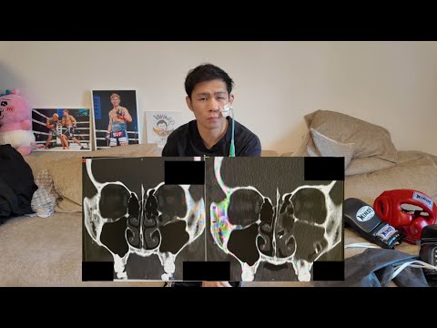 Details about missing the game due to an orbital floor fracture