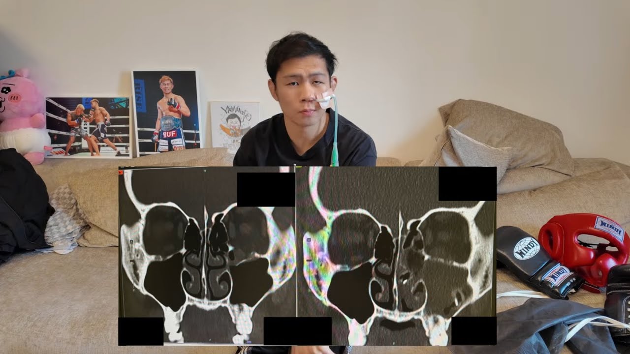 眼窩底骨折して試合欠場した詳細について