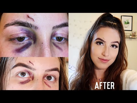 HOW TO COVER A BLACK EYE WITH MAKEUP