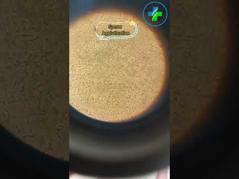 Semen analysis | sperm Agglutination | sperm under microscope | Sperm count | male fertility test