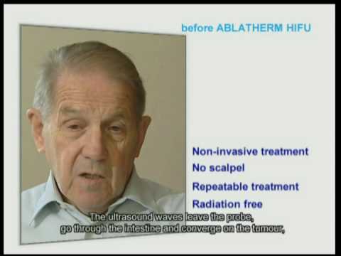 Robotic HIFU patient's testimony