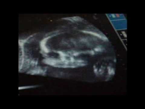 Verme di microscopio di uovo Lotta video contro parassiti in un corpo umano