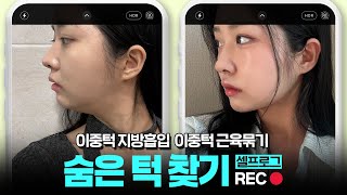 숨은 턱 찾는 방법 #이중턱지방흡입 #이중턱근육묶기