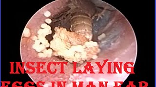 Alive Insect ( Fly ) Removal from ear &amp; one more surprise inside