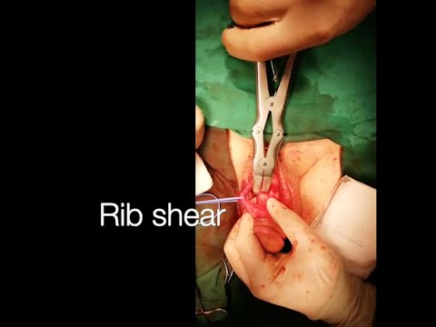 A Dense Fibrotic Plaque Cutting With Rib Shear İn The Patient Who Had Peyronie's Disease
