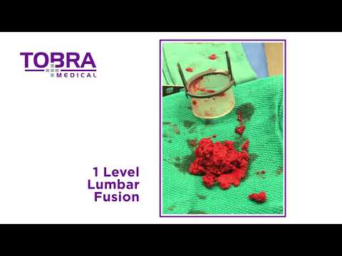 Tobra Bone Basket Video