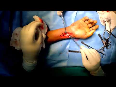 FCR Approach, Fracture Distal Radius - Dr Sunny Dole