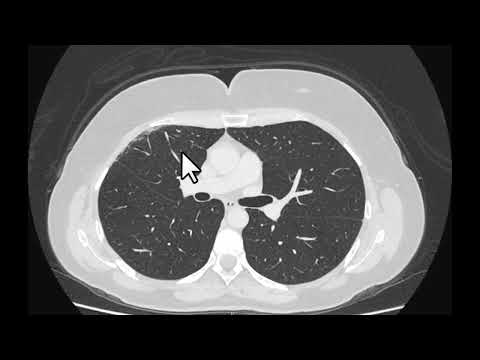 Alterações pulmonares provocadas pela radioterapia no câncer de mama. Achados tomográficos.