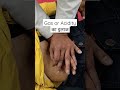 Gas Or Acidity का इलाज Shorts Chiropractor Rehabilitation Gas Acidity Drjitendrajaiswal