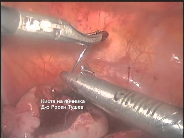 Ovarian cyst / Киста на яйчника - Rossen Tushev M. D