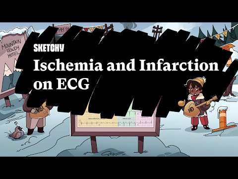 Ischemia & Infarction on ECG (Part 1) | Sketchy Medical | USMLE Step 2 CK