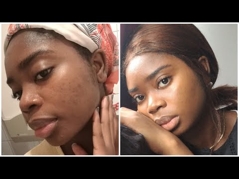 Schnell Hyperpigmentation und Pigmentflecken aufhellen | Ergebnis nach 1. Monat | Morgenroutine