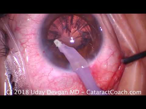 hyperopia műtét videó