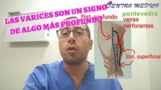 VARICES e Insuficiencia venosa. CÓMO TRATARLAS y prevenirlas.