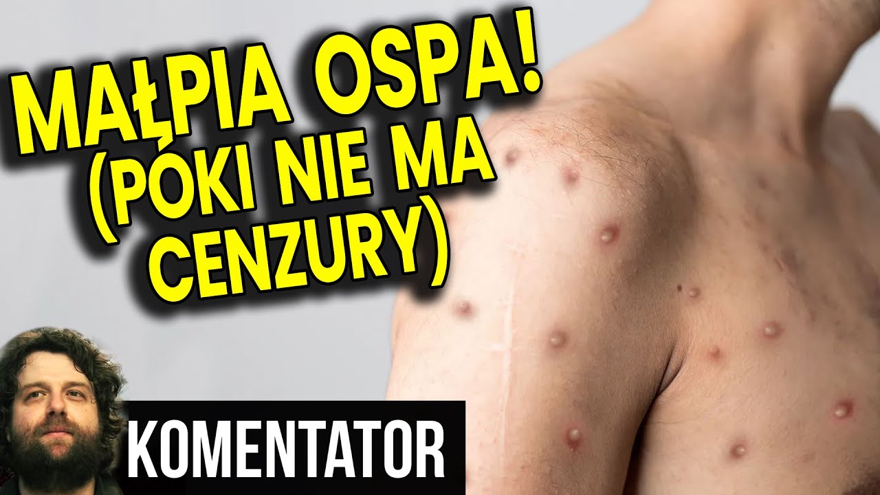 Malpia ospa posluchaj co mowia lekarze