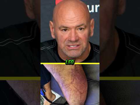 😳🦵 DANA WHITE SHOCKED OVER MAX HOLLOWAY’S LEG AFTER BMF TITLE FIGHT WITH JUSTIN GAETHJE AT UFC 300