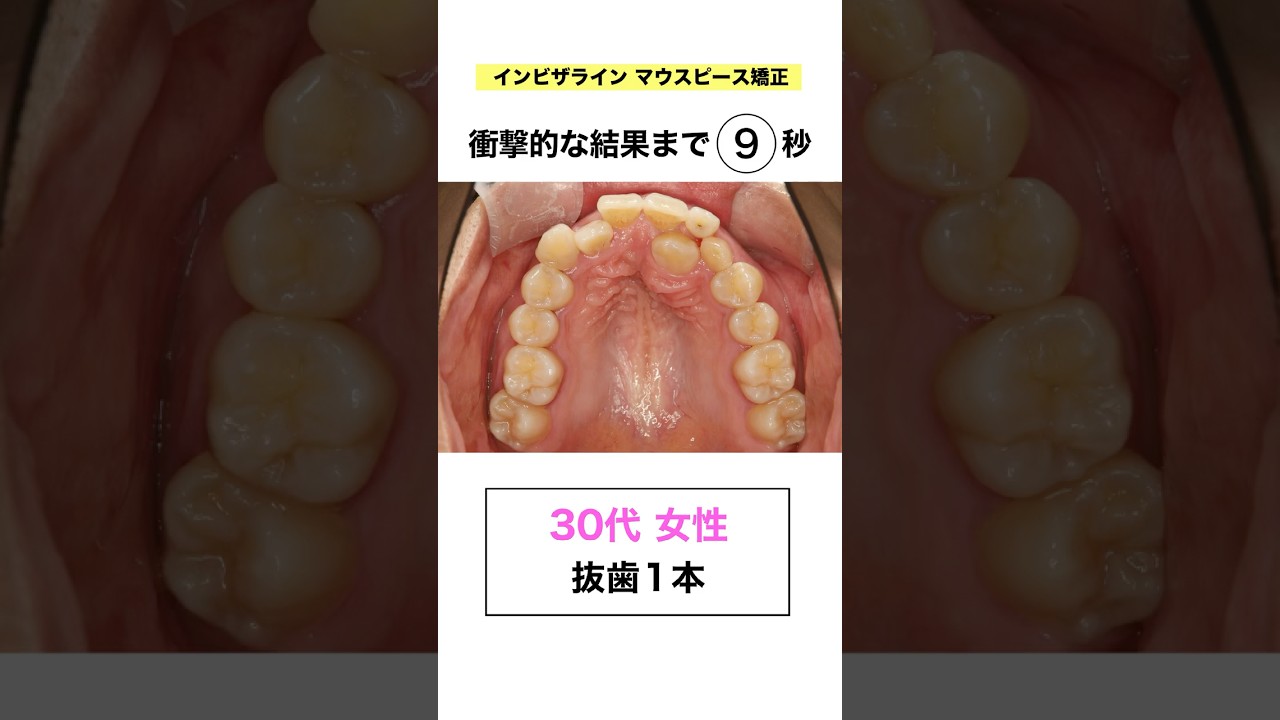 ワイヤーではなくマウスピース矯正したい方必見！#インビザライン #歯列矯正 #さいとう矯正歯科