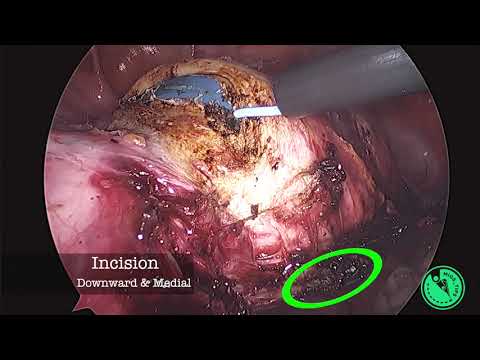 Całkowita histerektomia laparoskopowa: kolpotomia