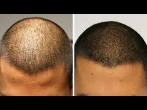 Hair Transplant Treatment Service