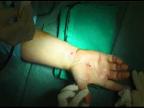 Potrebbe essere un colpo di tosse da malattia degenerativa del disco della colonna cervicale Trattamento medico Bubnovsky di ginocchio