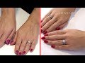 Hand Rejuvenation and Filler I Between the Before and After Ep. 1 | NewBeauty Hand Rejuvenation and Filler I Between the Before and After Ep. 1 | NewBeauty