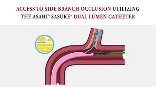 Access to Side Branch Occlusion: Dual-Lumen Catheter Technique
