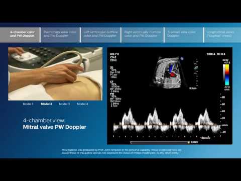 image-What is a Doppler ultrasound of the heart?