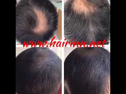 Hair Inn - Saç Simulasyonu Örnekleri