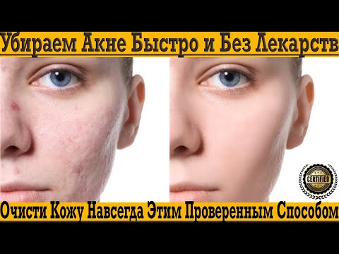 АКНЕ больше НЕТ! Очисти кожу навсегда уже сегодня! АКНЕ больше НЕТ! Очисти кожу навсегда уже сегодня!