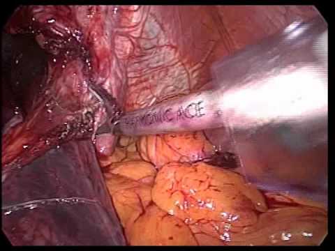 Wewnątrzklatkowa Operacja Przepukliny Wpustu - Laparoskopia
