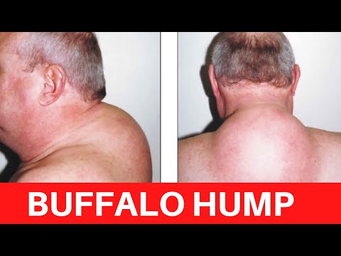 leder Fødested discolor Buffalo hump - How To Discuss