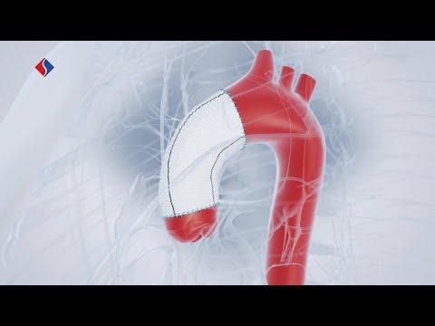 Aortic Surgery | Medical Animation