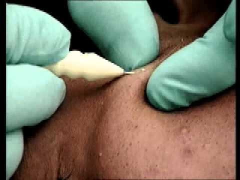 Parassiti in sentiero intestinale zheludochno della persona Parassiti cellulari della persona