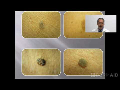 Seborrheic Keratoses