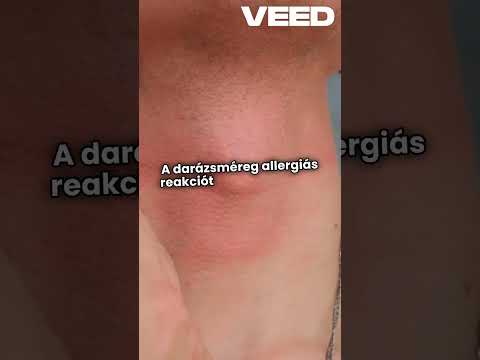 Ai videók kicsit másképp: A darázs csípés miért veszélyes? Tények, információk a darázs csípésről.