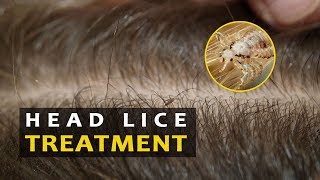 How to get rid of lice fast and Naturally | Head lice treatment