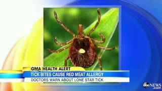 Ticks and Red Meat Allergies