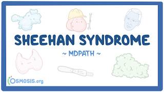 Sheehan syndrome